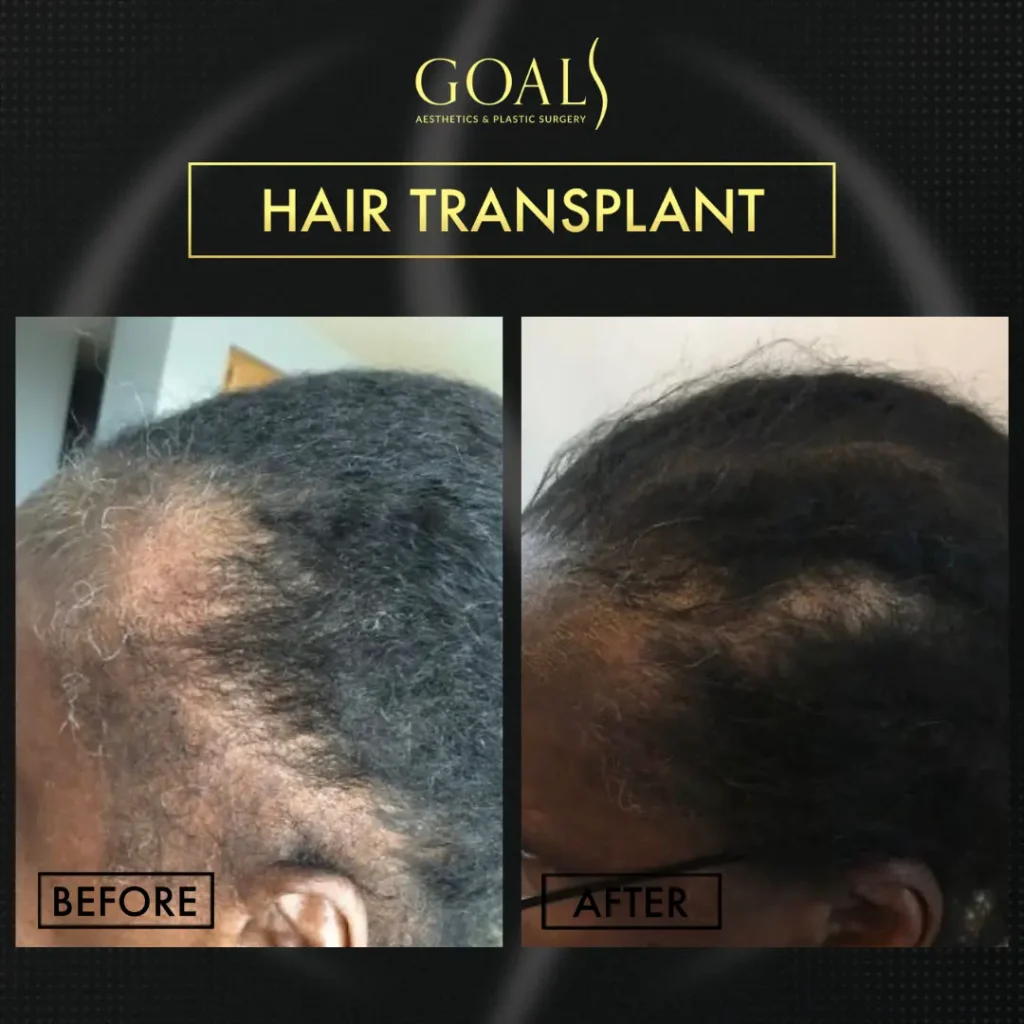 Before and after — FUE Hair Transplant · Central Park, patient 1