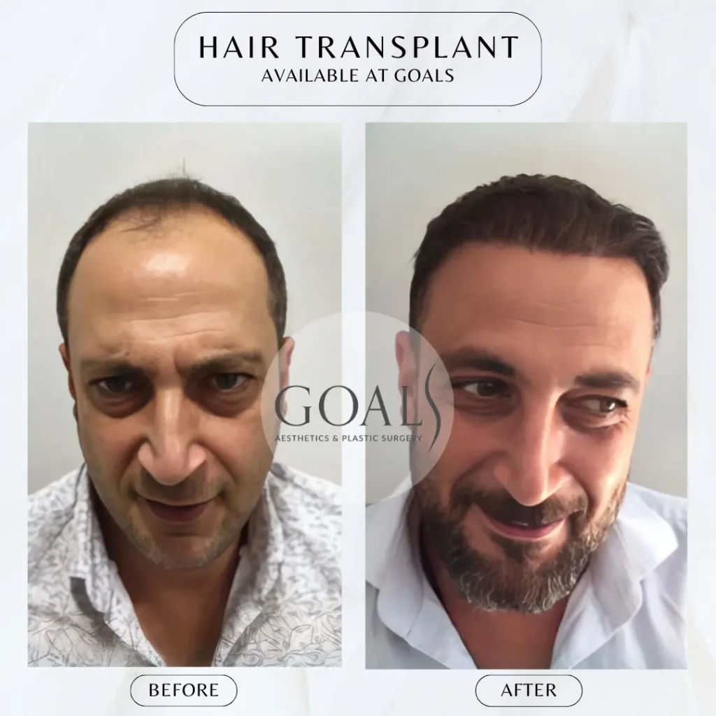 Before and after — FUE Hair Transplant · Central Park, patient 2