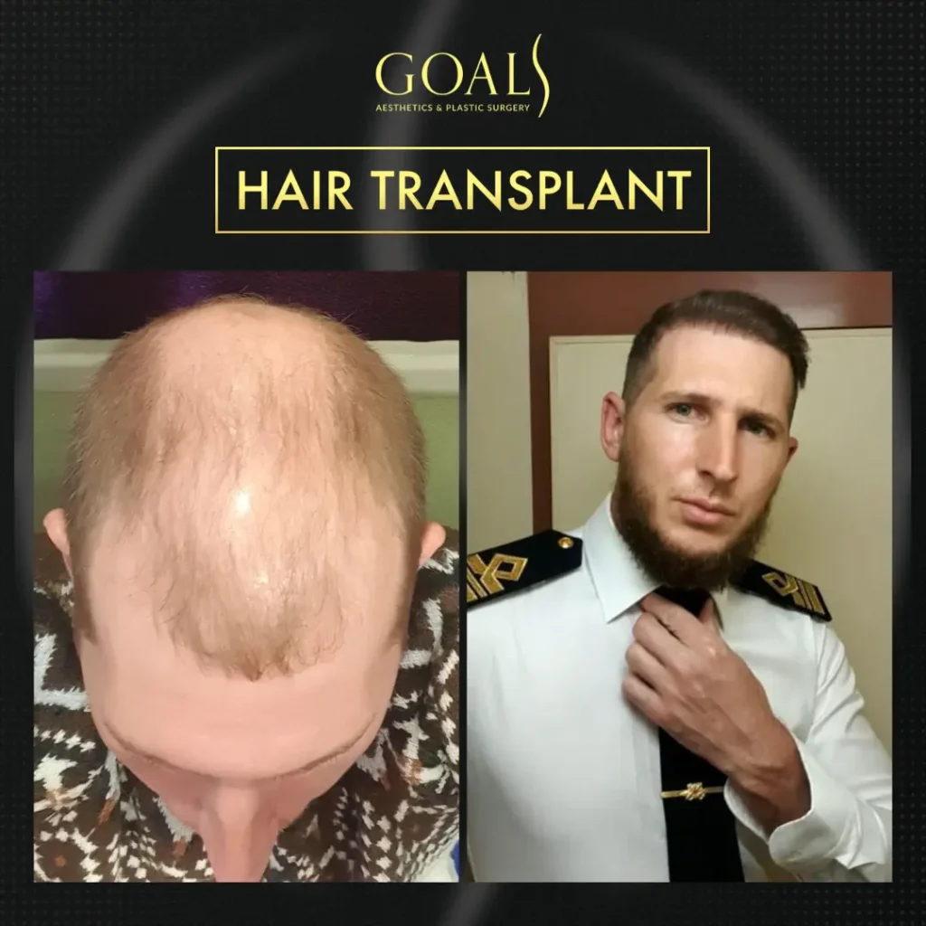Before and after — FUE Hair Transplant · Central Park, patient 3