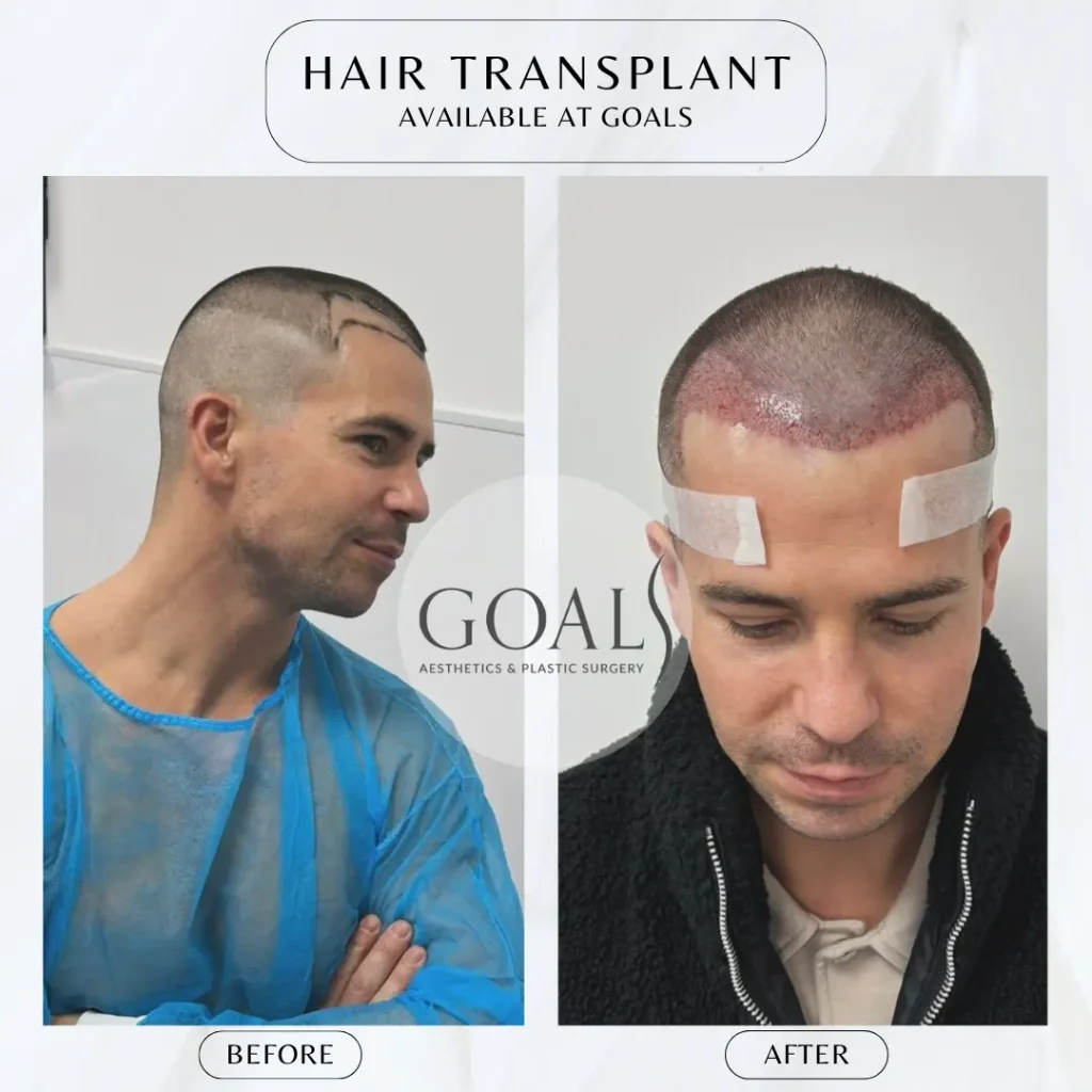 Before and after — FUE Hair Transplant · Central Park, patient 4
