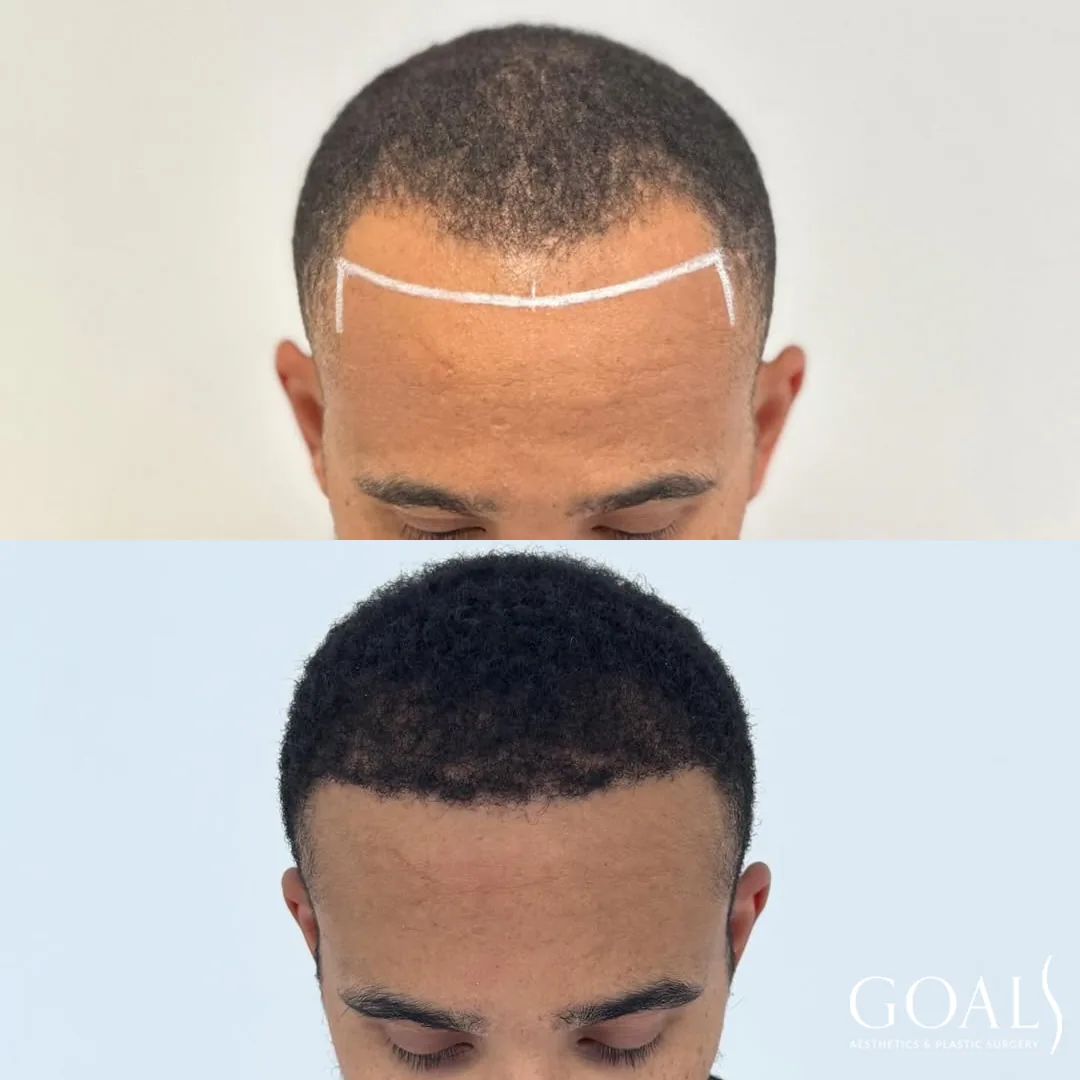 Before and after — FUE Hair Transplant · Central Park, patient 5