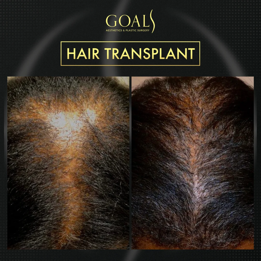 Before and after — FUE Hair Transplant · Central Park, patient 6