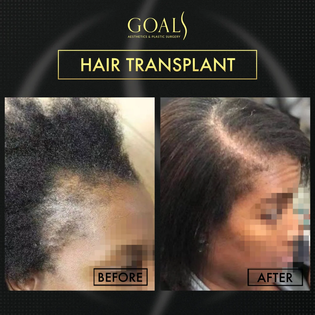 Afro Hair Transplant — patient result