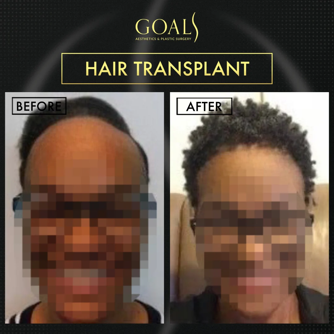 Before and after — Men's Hair Transplant · Atlanta Walton St., patient 3