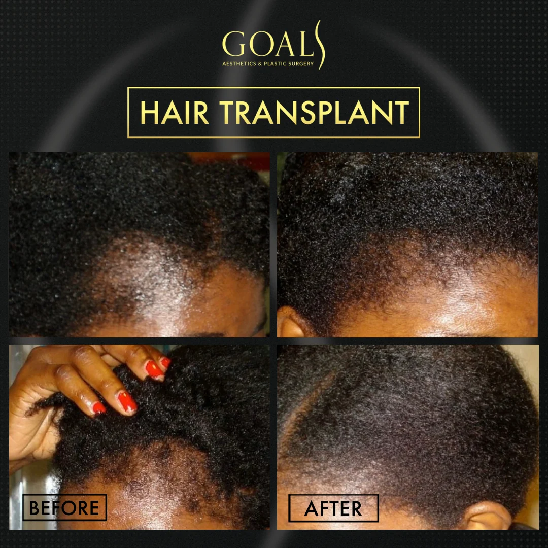 Before and after — Afro Hair Transplant, patient 2