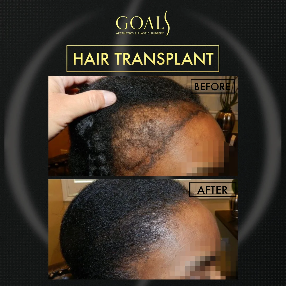 Before and after — Afro Hair Transplant, patient 3
