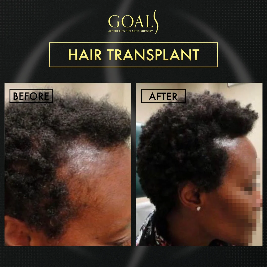 Before and after — Afro Hair Transplant, patient 4