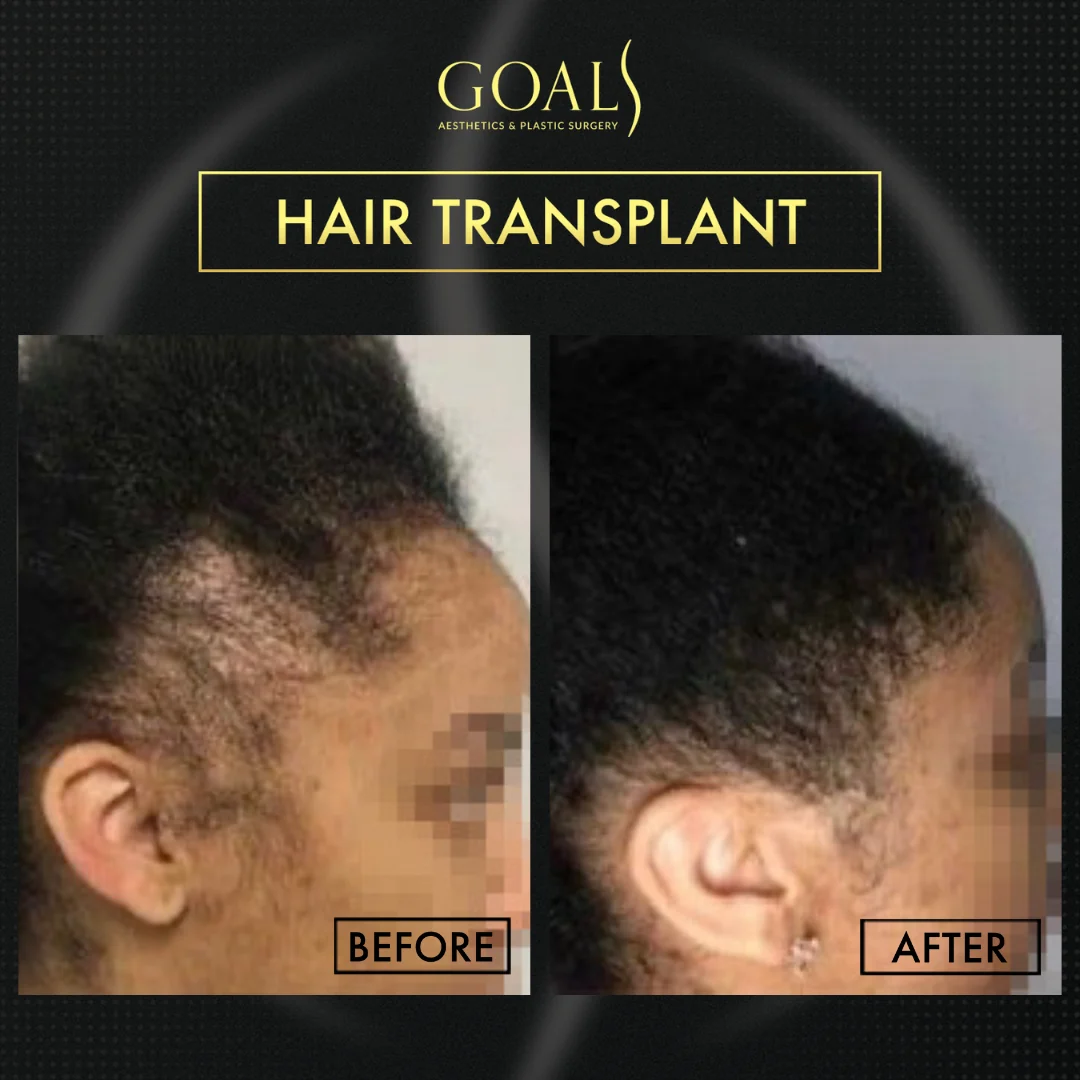 Before and after — Afro Hair Transplant, patient 5