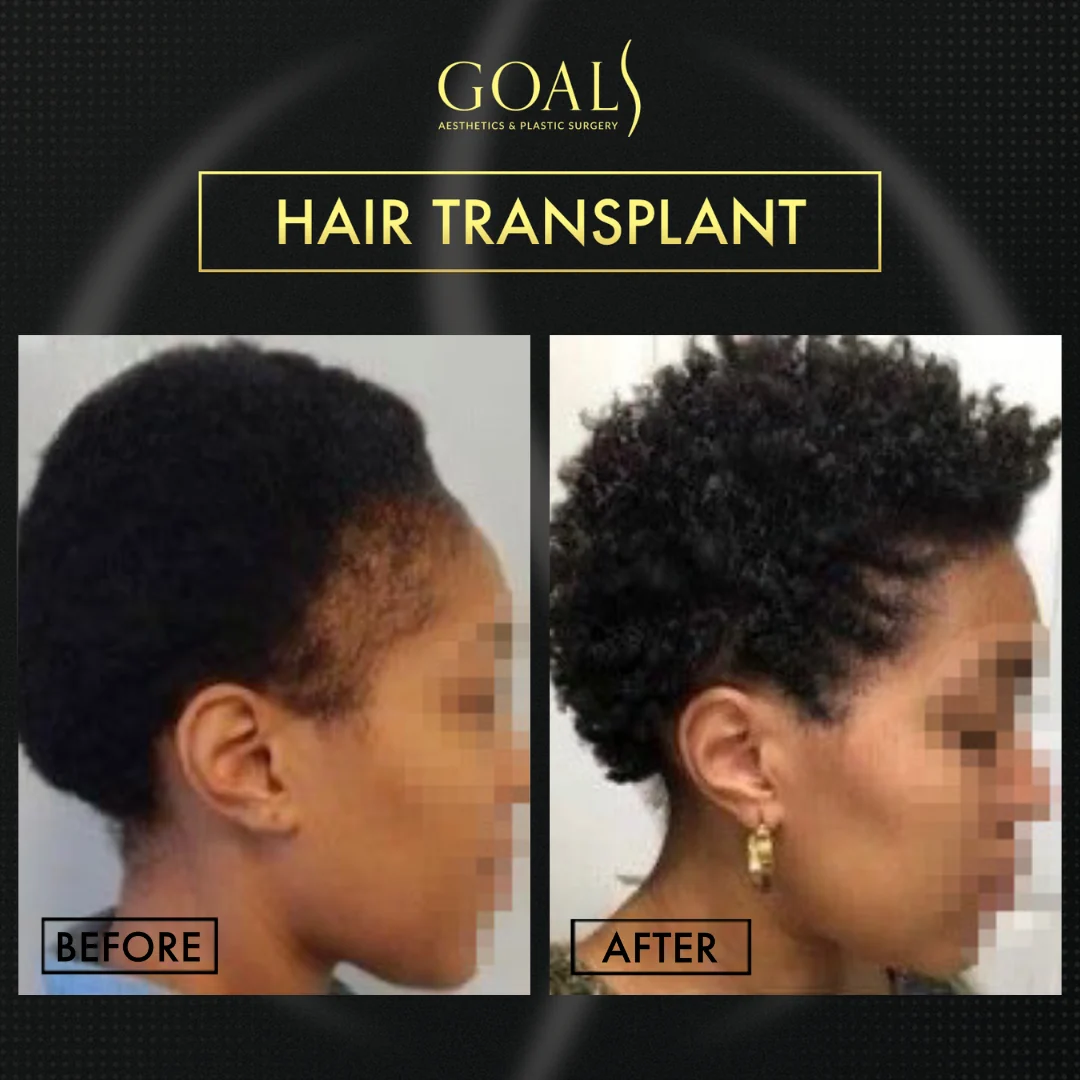 Before and after — Afro Hair Transplant, patient 6