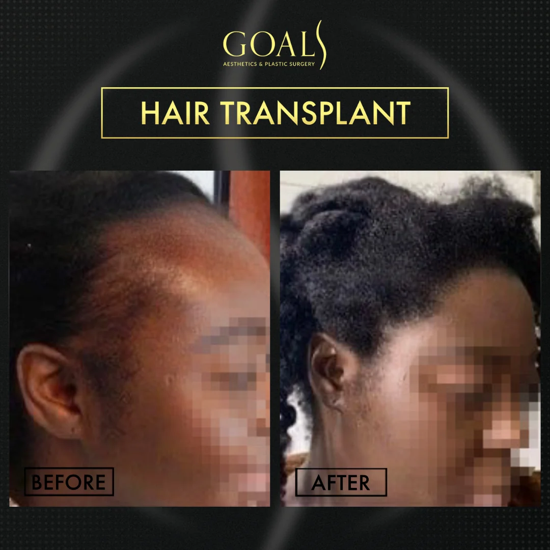 Before and after — Trasplante Capilar para Mujeres, patient 1