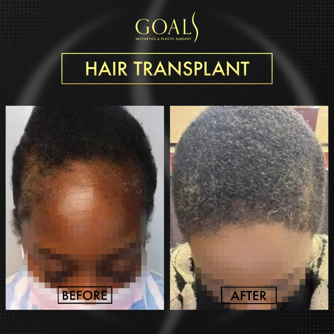 Before and after — FUE Hair Transplant, patient 1