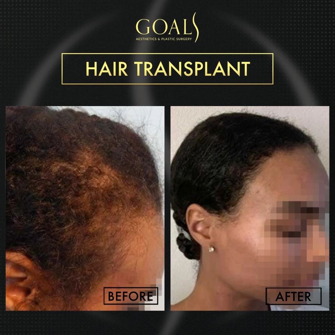 Before and after — FUE Hair Transplant, patient 2