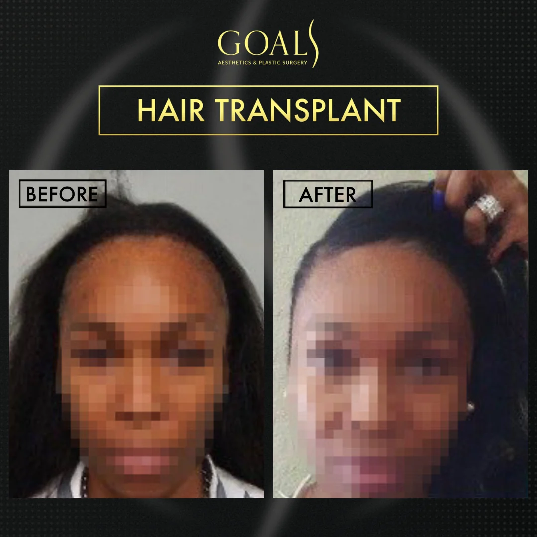 Before and after — FUE Hair Transplant, patient 3