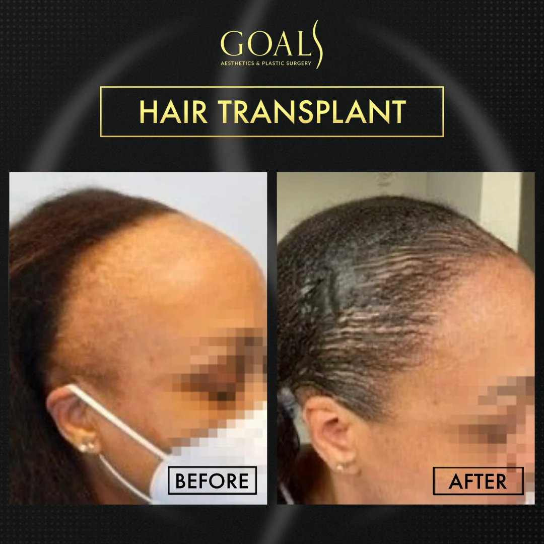 Before and after — FUE Hair Transplant, patient 4