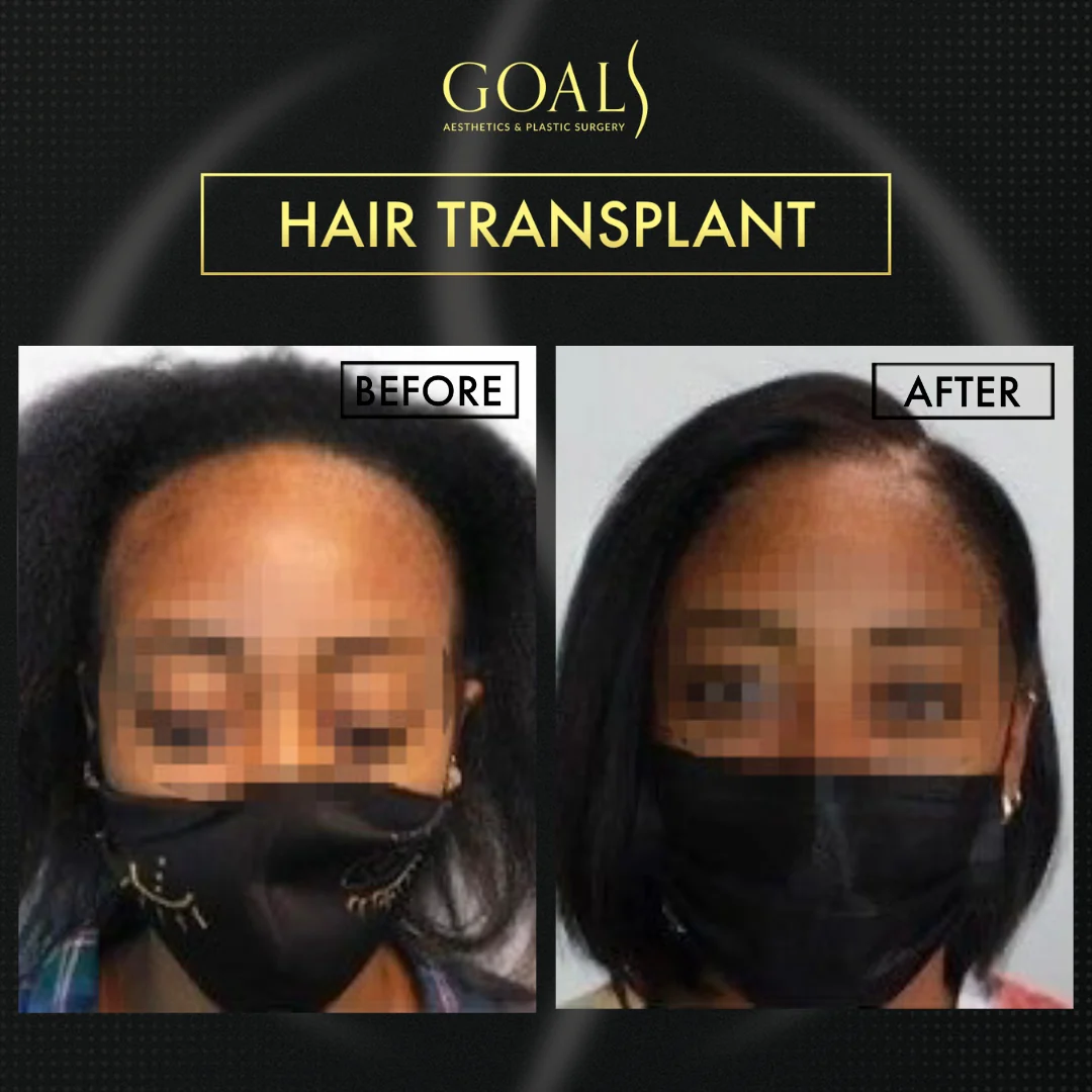 Before and after — FUE Hair Transplant, patient 5