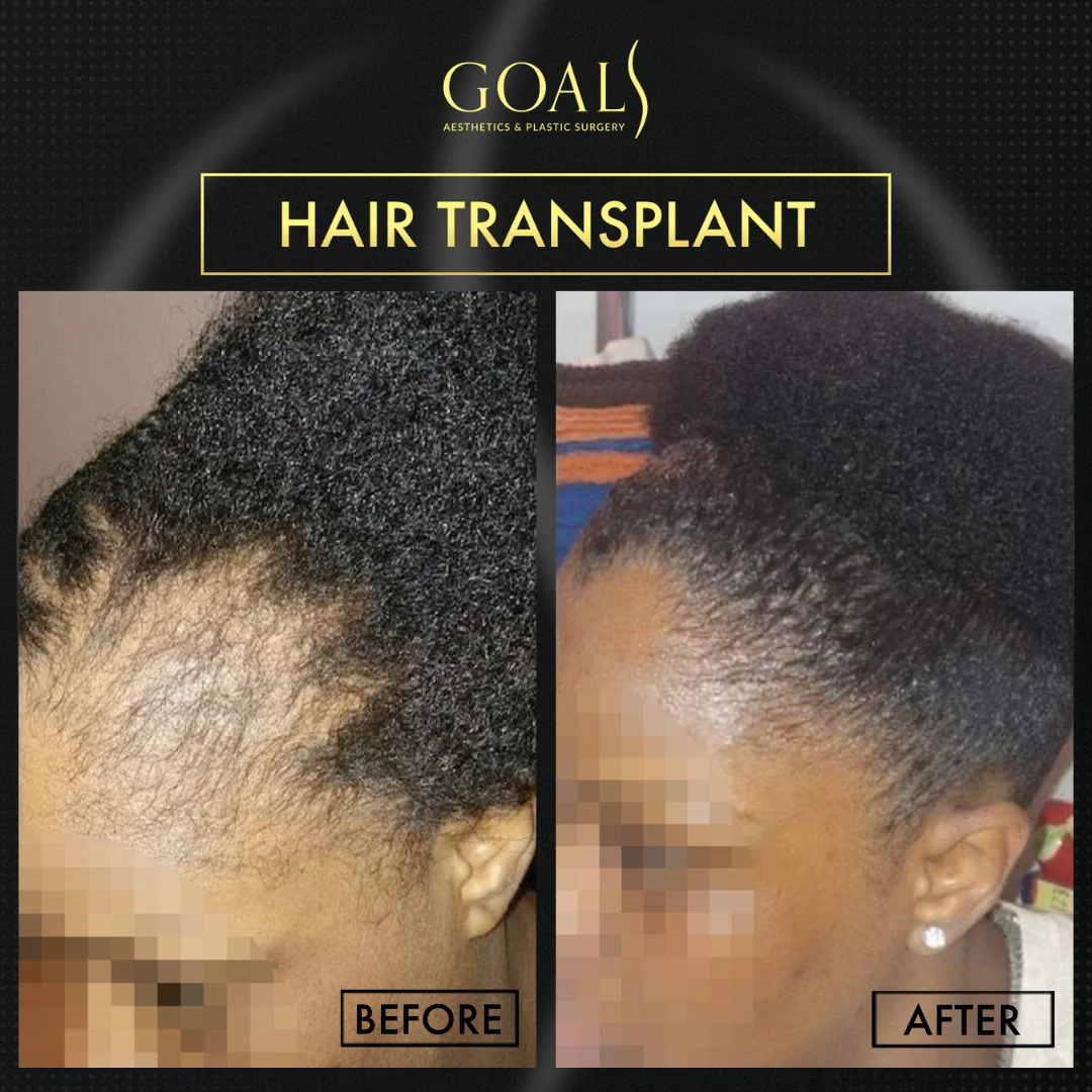 Before and after — FUE Hair Transplant, patient 6