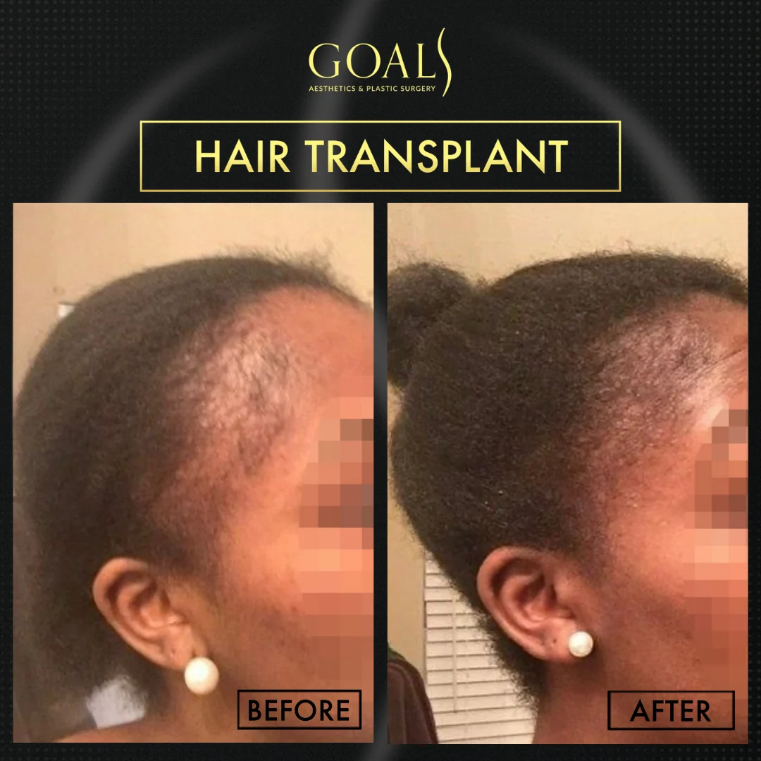 Before and after — Afro Hair Transplant · Central Park, patient 2