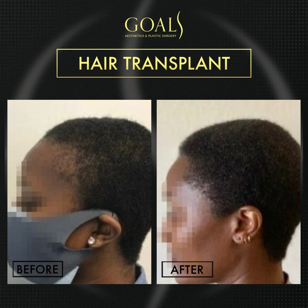Before and after — Afro Hair Transplant · Central Park, patient 3
