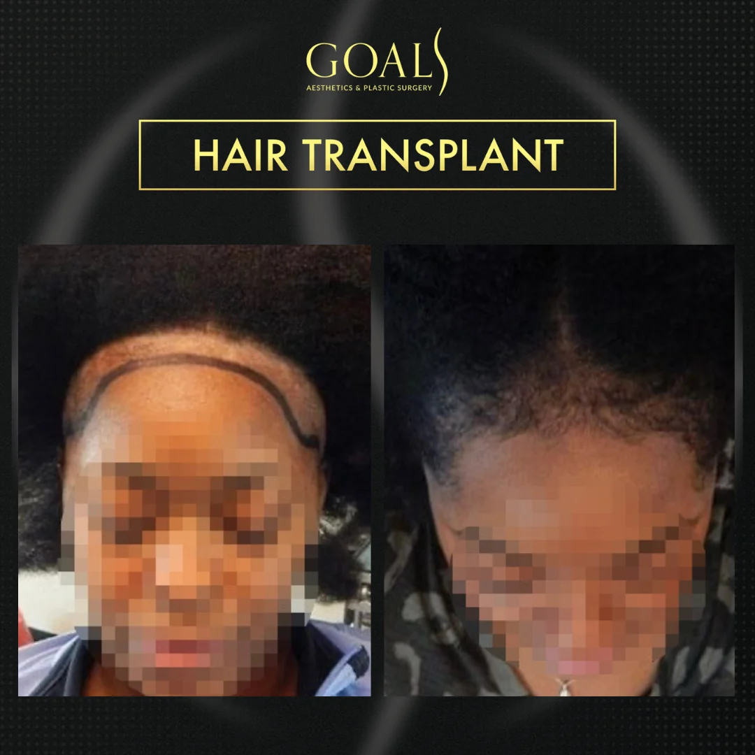 Before and after — Afro Hair Transplant · Central Park, patient 4