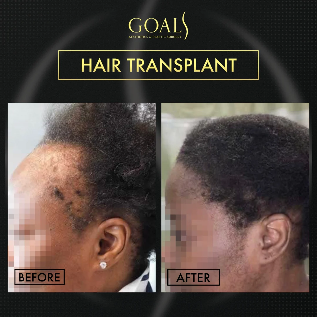 Before and after — Afro Hair Transplant · Central Park, patient 5