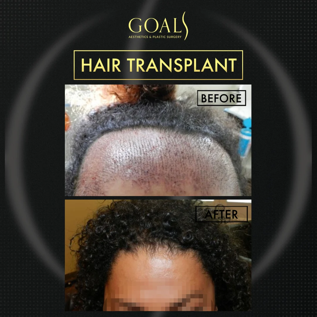 Before and after — Afro Hair Transplant · Central Park, patient 6