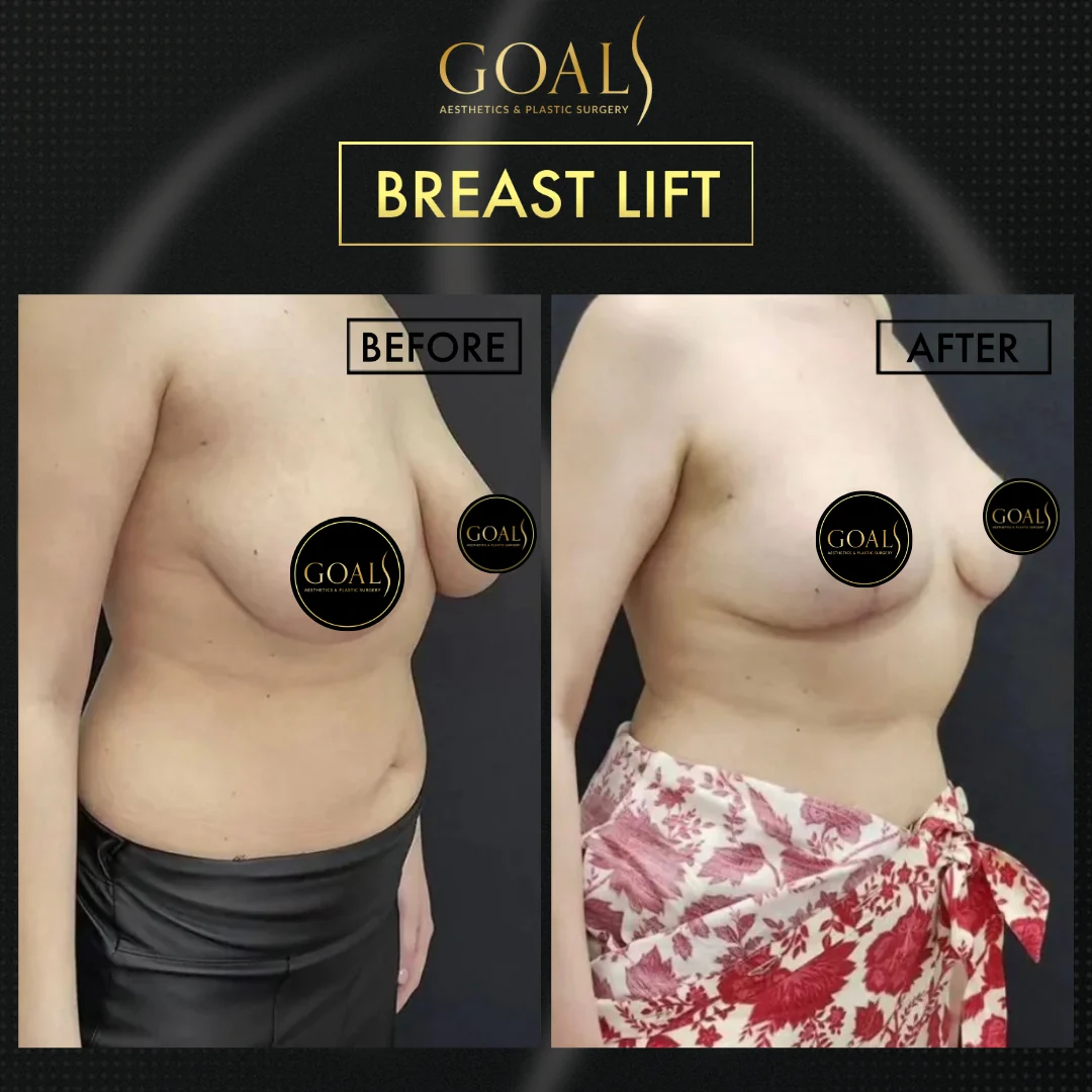 Before and after — Breast Lift, patient 4