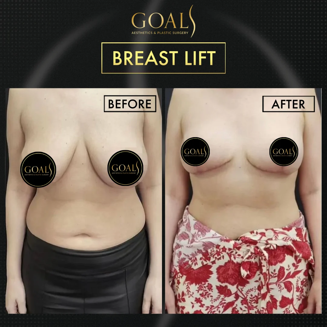 Before and after — Breast Lift, patient 5