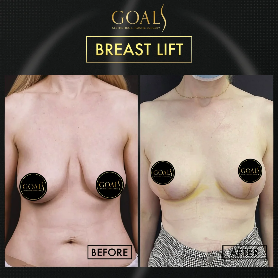Before and after — Breast Lift · Gaithersburg, patient 1