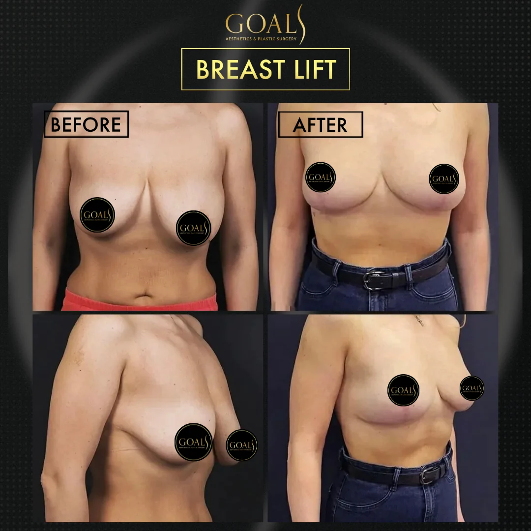 Before and after — Breast Lift, patient 3
