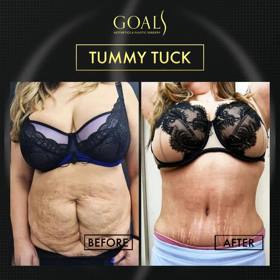 Before and after — Tummy Tuck · Brooklyn, patient 2