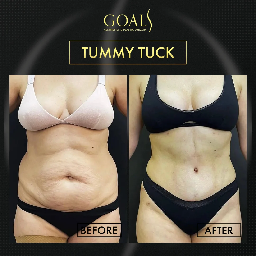 Before and after — Tummy Tuck · Brooklyn, patient 3