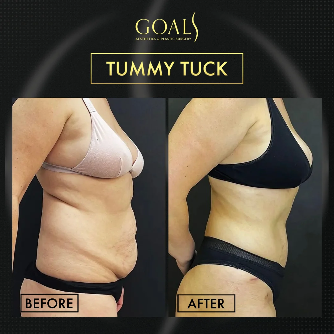 Before and after — Tummy Tuck · Brooklyn, patient 4