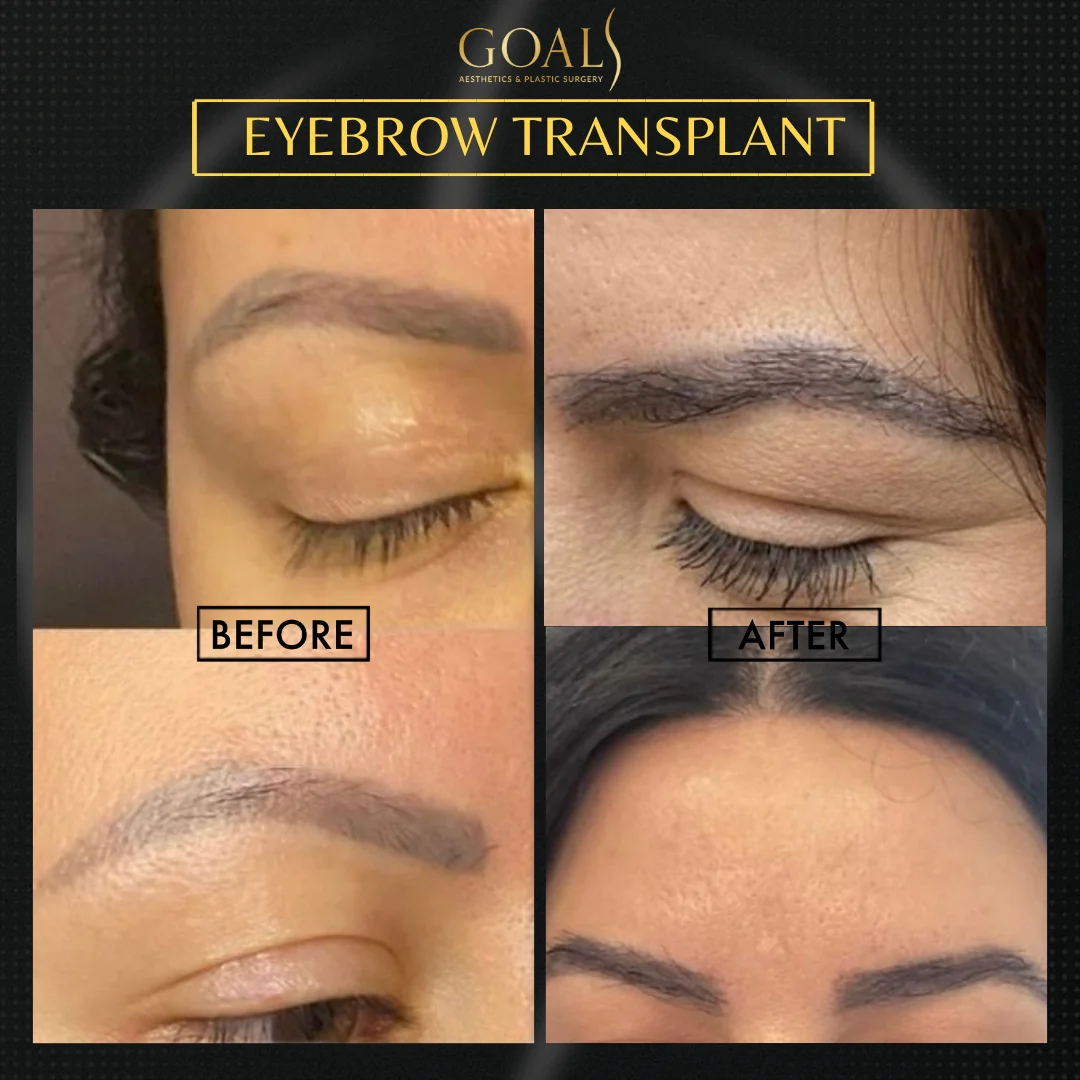 Before and after — Eyebrow Hair Transplant, patient 3