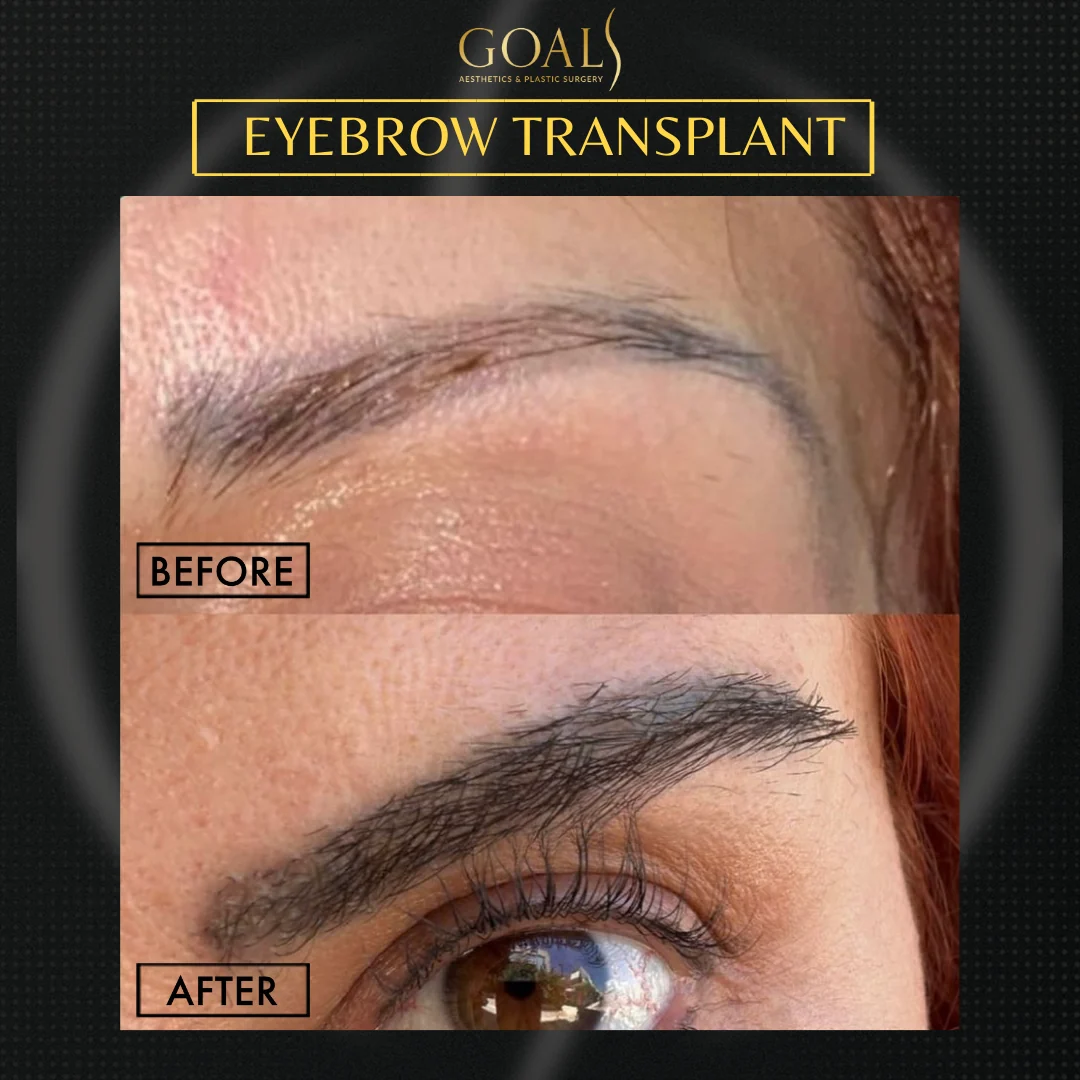 Before and after — Eyebrow Hair Transplant, patient 4