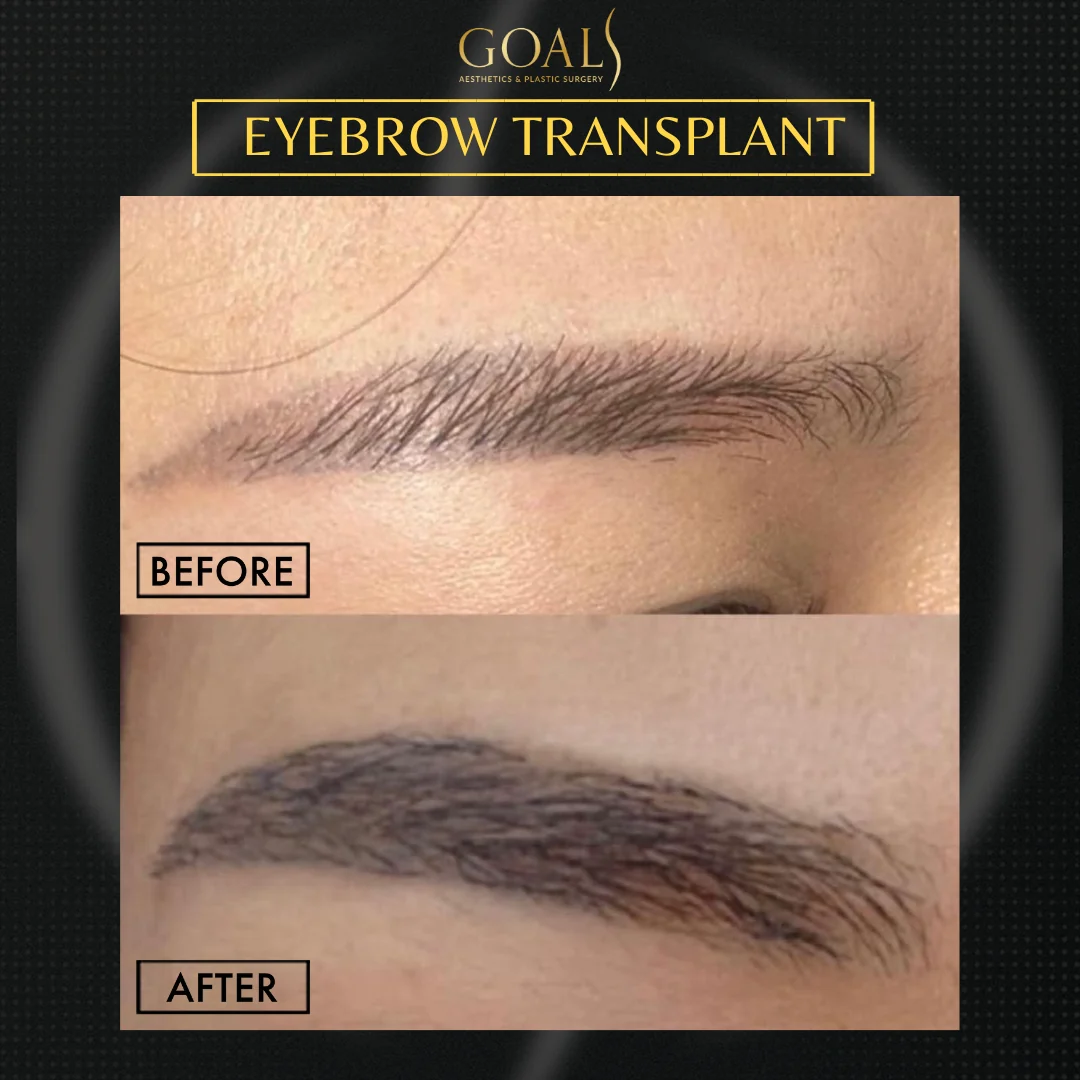 Before and after — Eyebrow Hair Transplant, patient 5