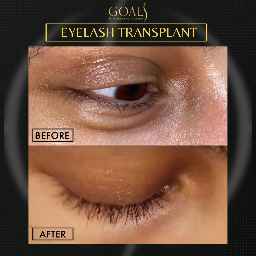 Before and after — Eyelash Hair Transplant · Atlanta Walton St., patient 1