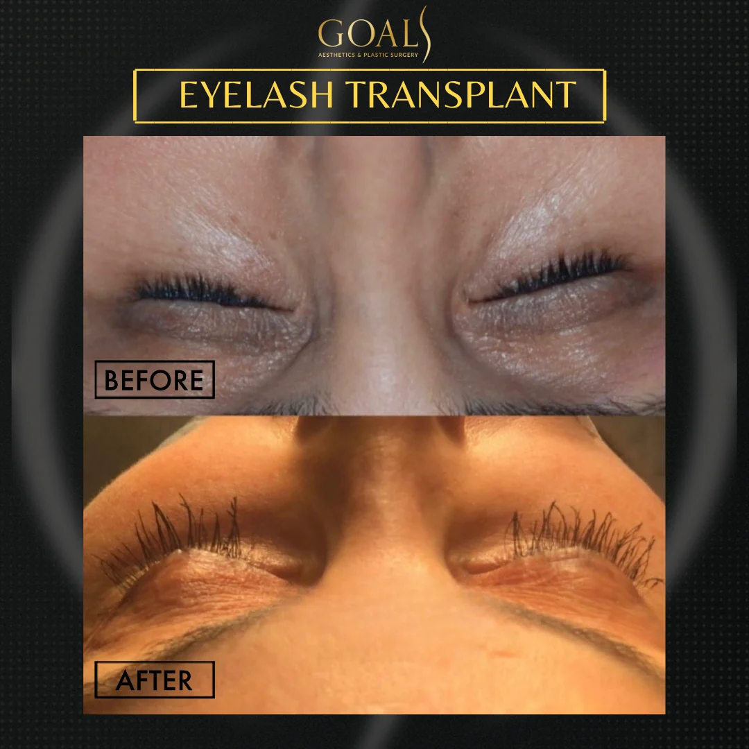 Before and after — Eyelash Hair Transplant · Atlanta Walton St., patient 2