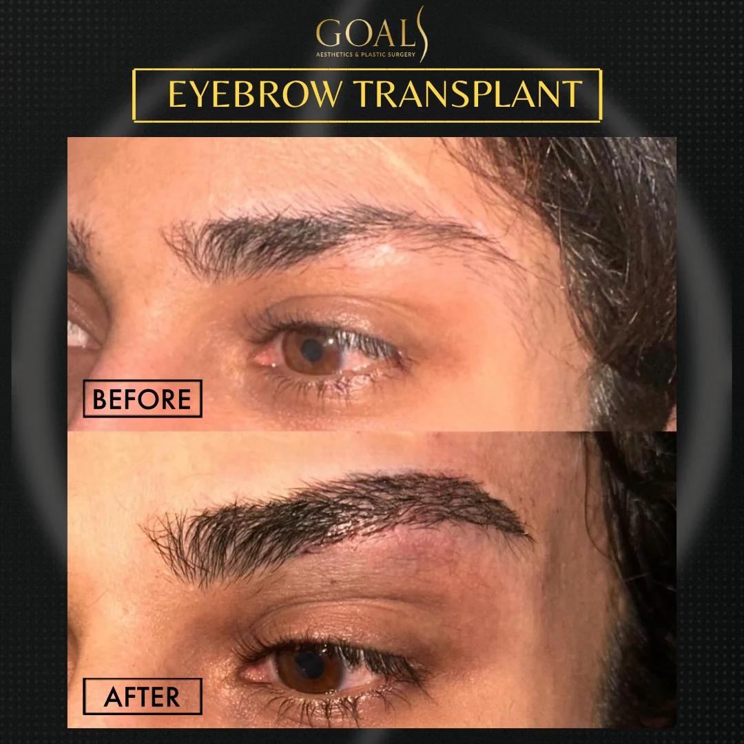 Before and after — Trasplante de Cejas, patient 6