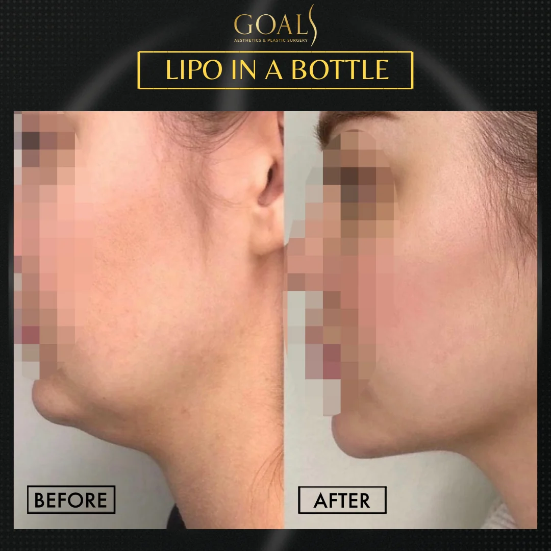 Before and after — Fat Loss Shots · Harlem, patient 1