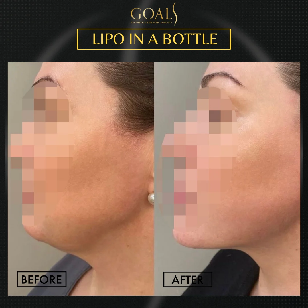 Before and after — Fat Loss Shots · Harlem, patient 2