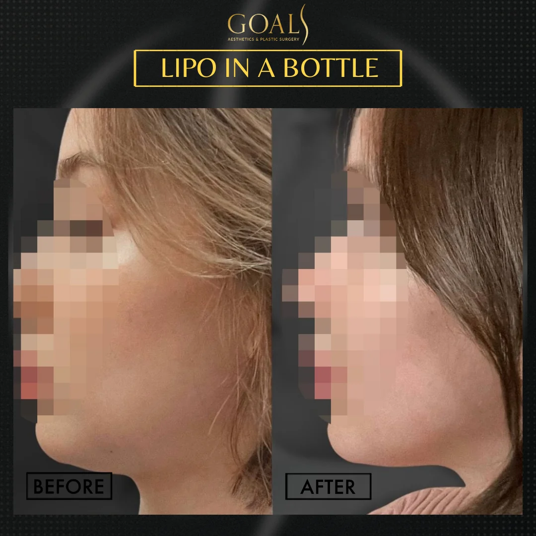 Before and after — Fat Loss Shots · Harlem, patient 3