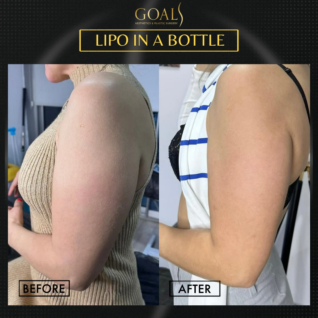 Before and after — Fat Loss Shots · Harlem, patient 4