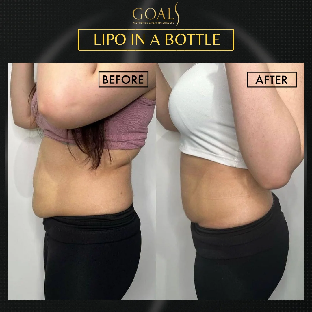 Before and after — Fat Loss Shots · Harlem, patient 5