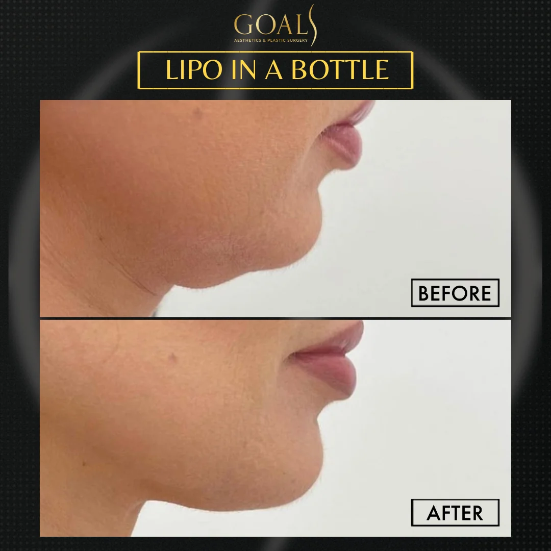 Before and after — Fat Loss Shots · Harlem, patient 6