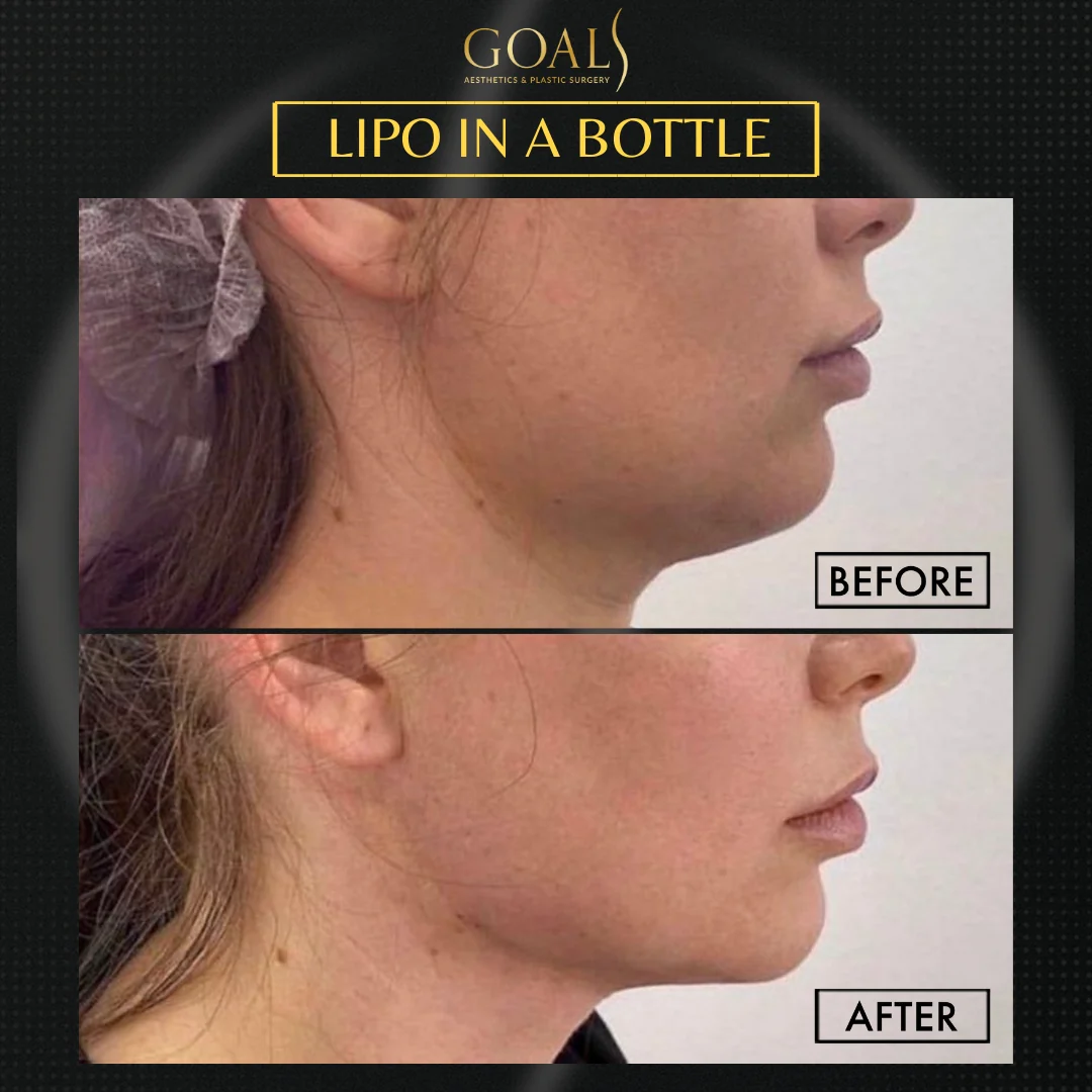 Before and after — Inyecciones para Reducir Grasa, patient 1
