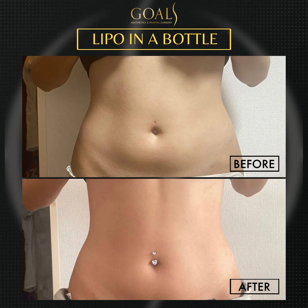 Before and after — Inyecciones para Reducir Grasa, patient 2