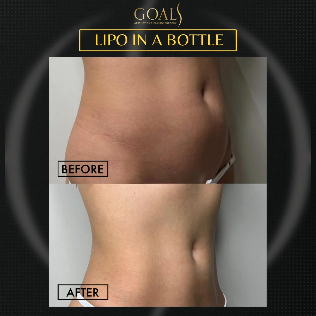 Before and after — Inyecciones para Reducir Grasa, patient 3