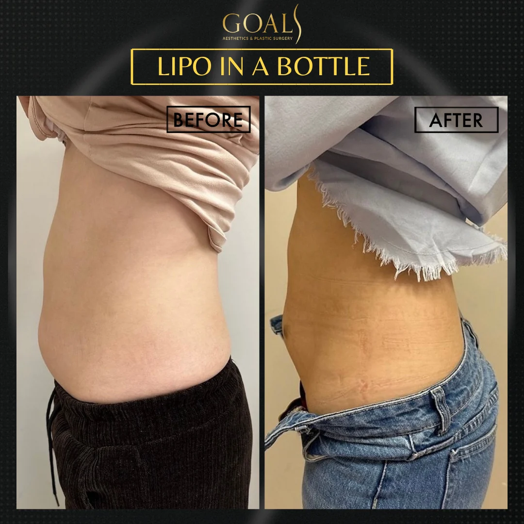 Before and after — Inyecciones para Reducir Grasa, patient 4