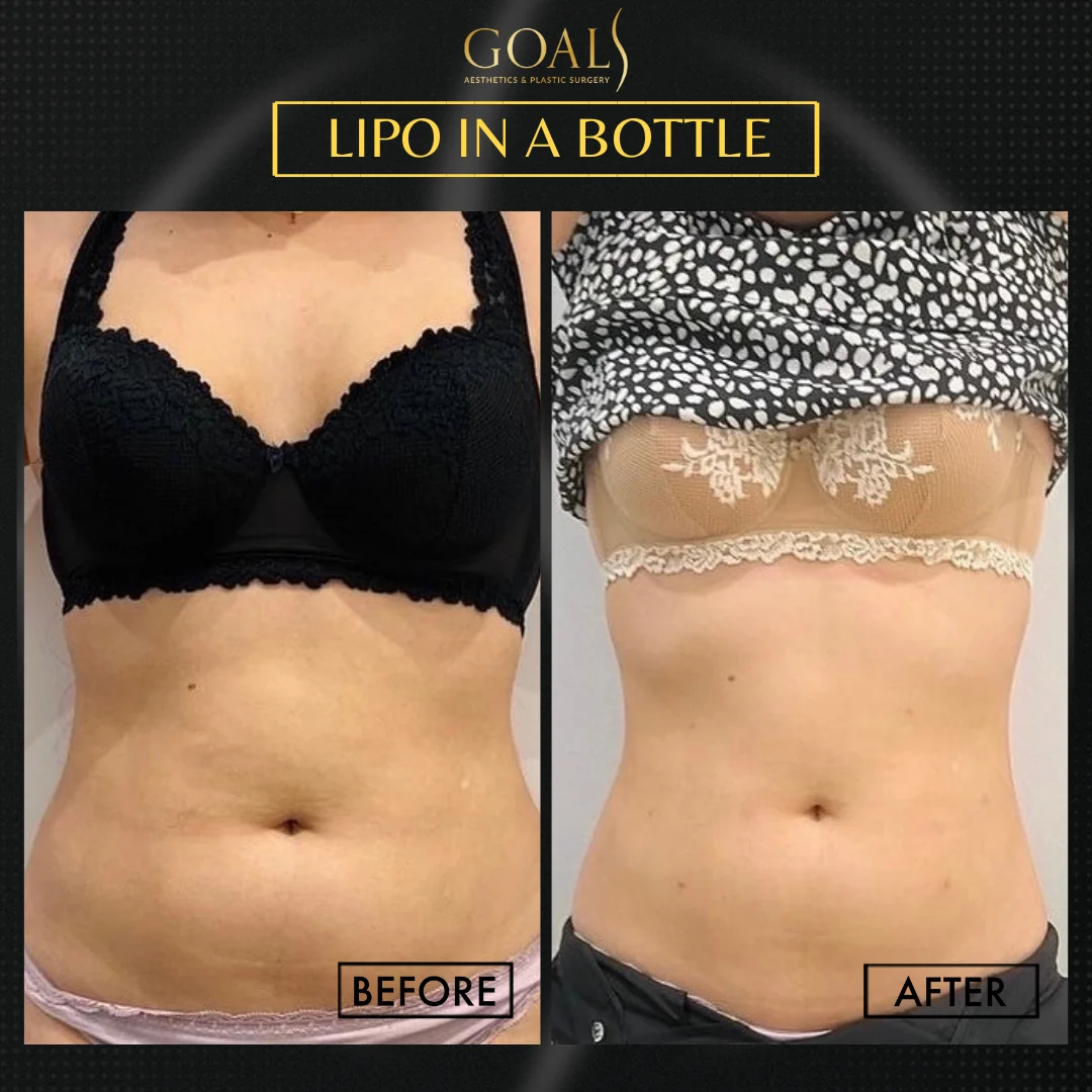 Before and after — Inyecciones para Reducir Grasa, patient 5
