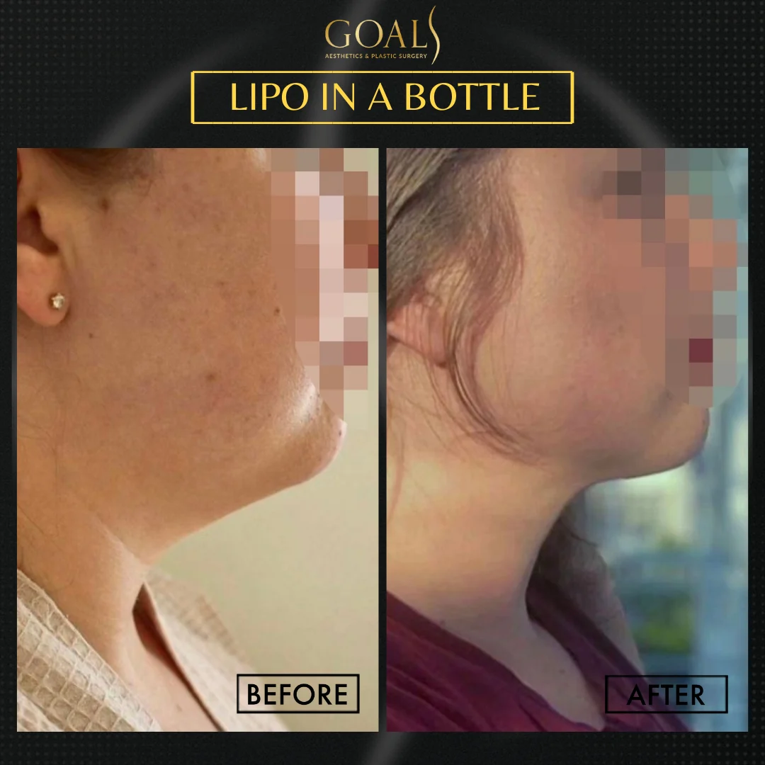 Before and after — Inyecciones para Reducir Grasa, patient 6